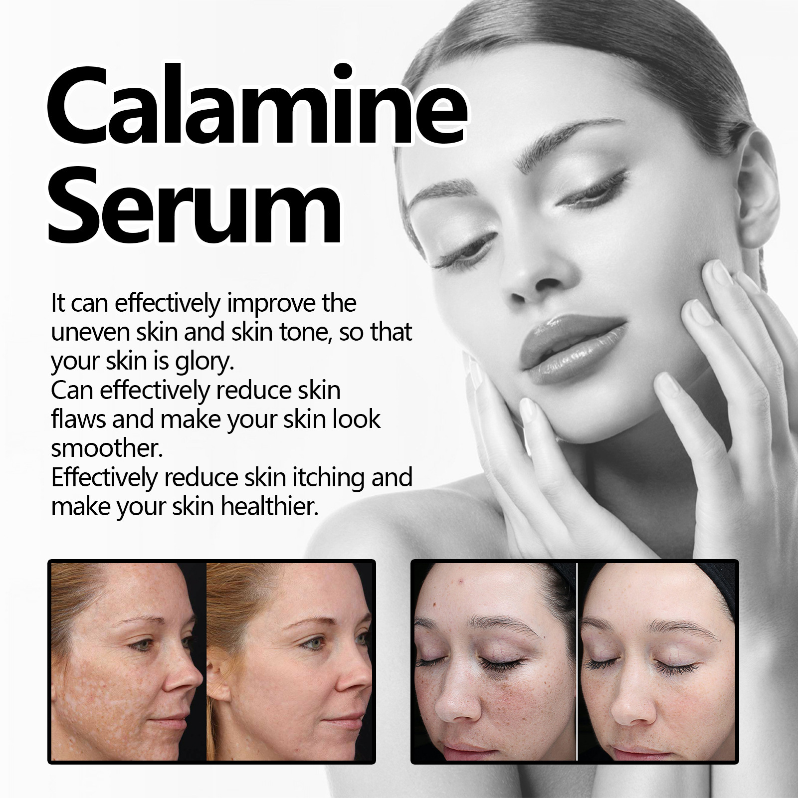 Esența facială de calamină Hoygi îmbunătățește uscăciunea, aspectul tern al pielii, acneea, hidratează și conferă volum pielii._voghion.com