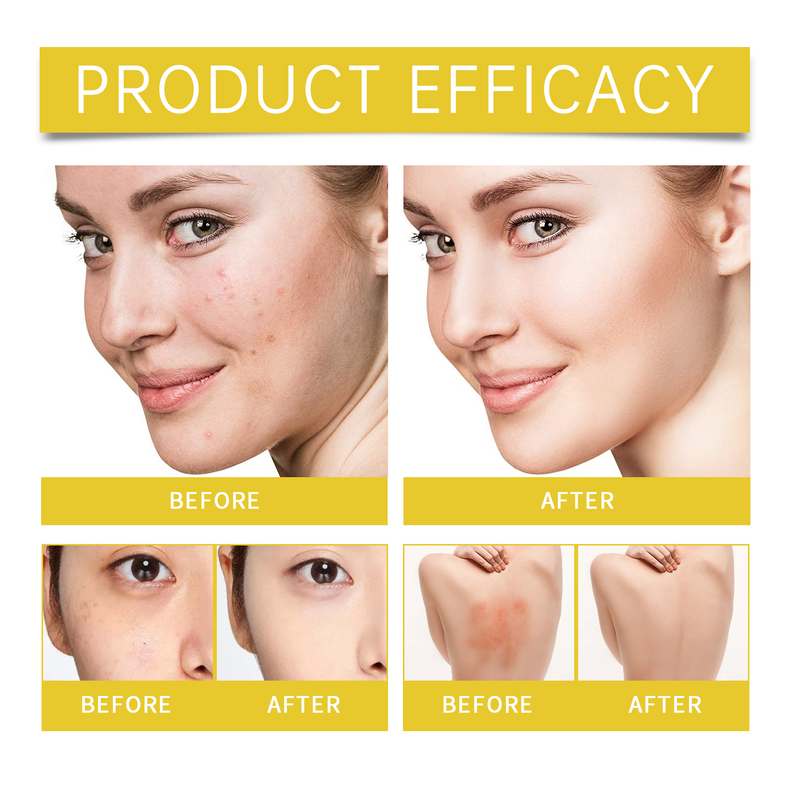 EELHOE Acne Skin Care Set Skin Care For Acne Skin Is Suitable For Moisturizing And Beautify Soft Skin_voghion.com