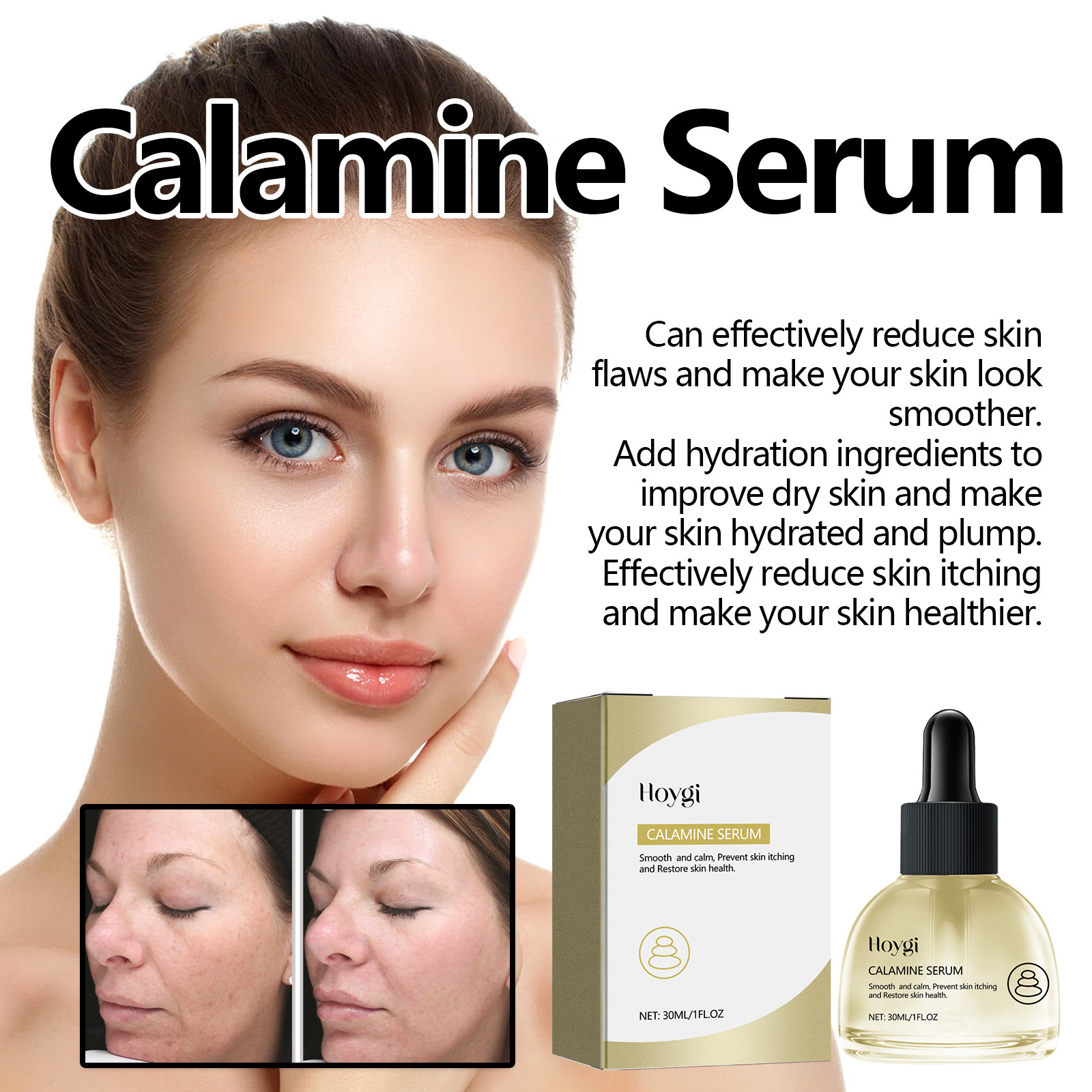 Esența facială de calamină Hoygi îmbunătățește uscăciunea, aspectul tern al pielii, acneea, hidratează și conferă volum pielii._voghion.com