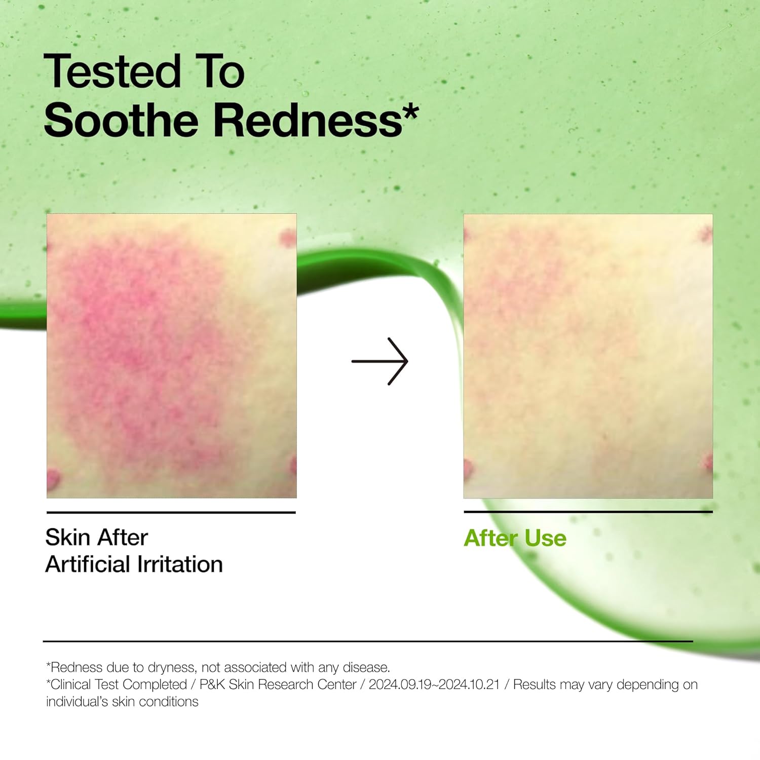 Ny Anua Azelaic Acid 10 Hyaluron Rødme Beroligende Serum Ansigtsserum_voghion.com