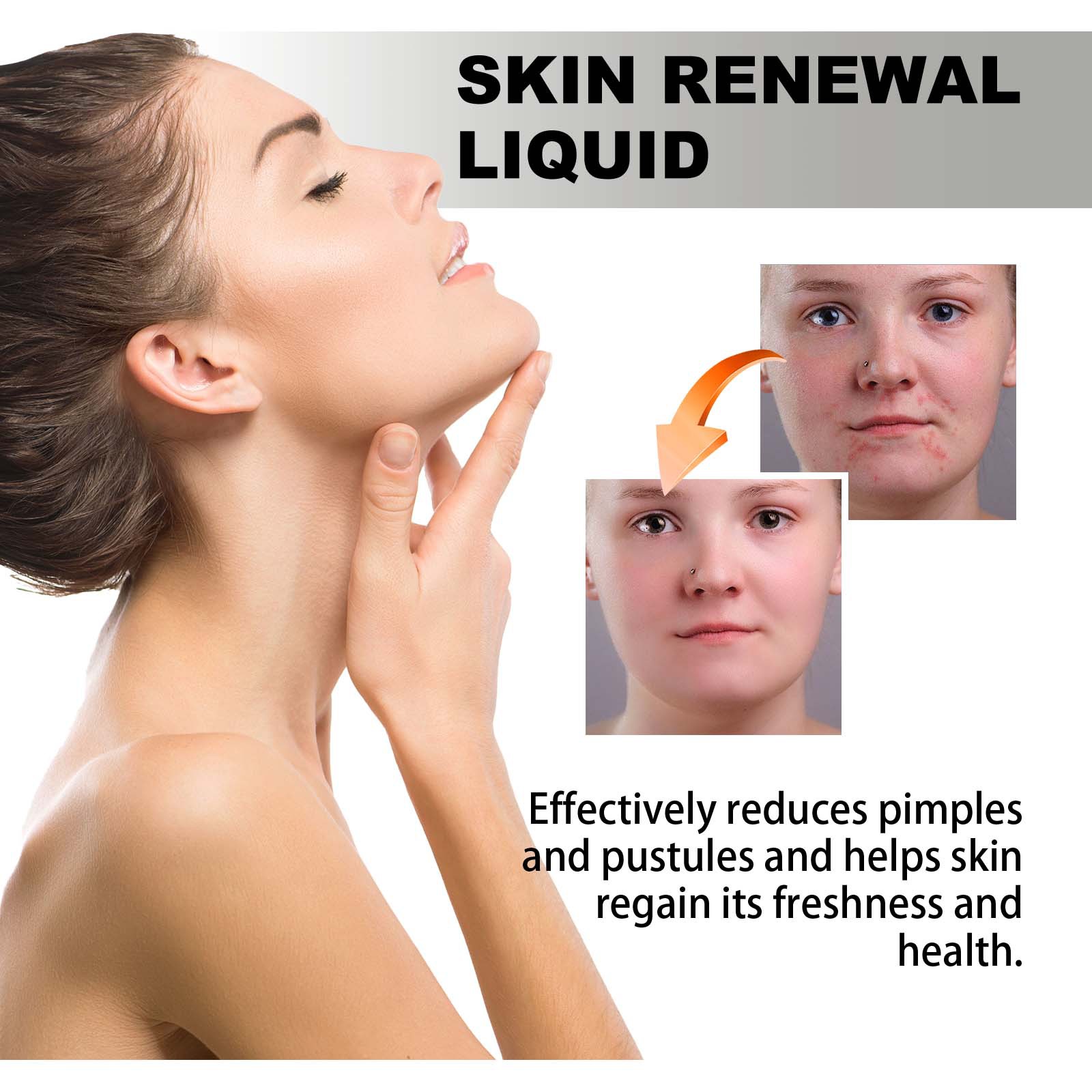 West&Month Salicylic Acid Acne Removing to fade marks, repair skin, mildly remove acne and moisturize essence_voghion.com