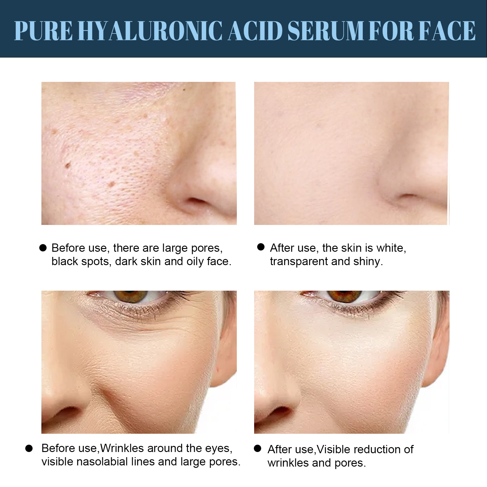 Linha de lifting de proteína EELHOE antirrugas para pele em V, lifting facial, firmeza, relaxamento dos contornos faciais, redução de medidas finas_voghion.com