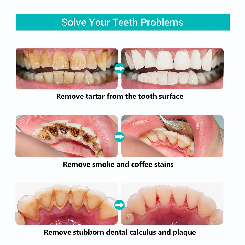 Dissolvant de tartre et de tartre dentaire, hygiène buccale, nettoyage Ultra sonique de la Plaque dentaire, pierre de nettoyage des dents, nouveauté 2023_voghion.com