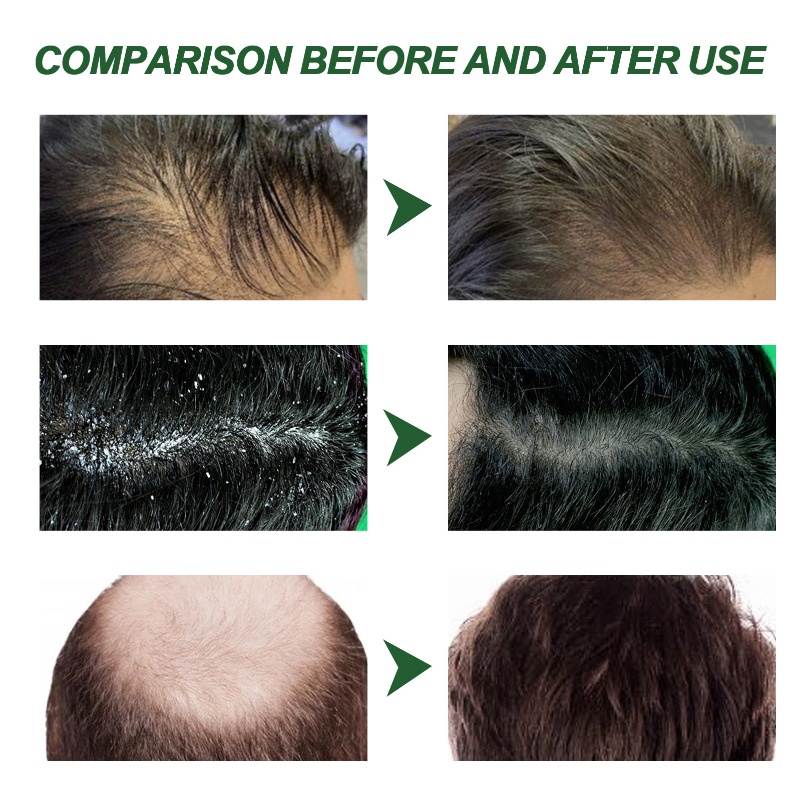 South Moon Ginger Series Kopfhautpflege – Reinigung, Pflege, Fixierung der Haarwurzeln und für dichtes Haar_voghion.com