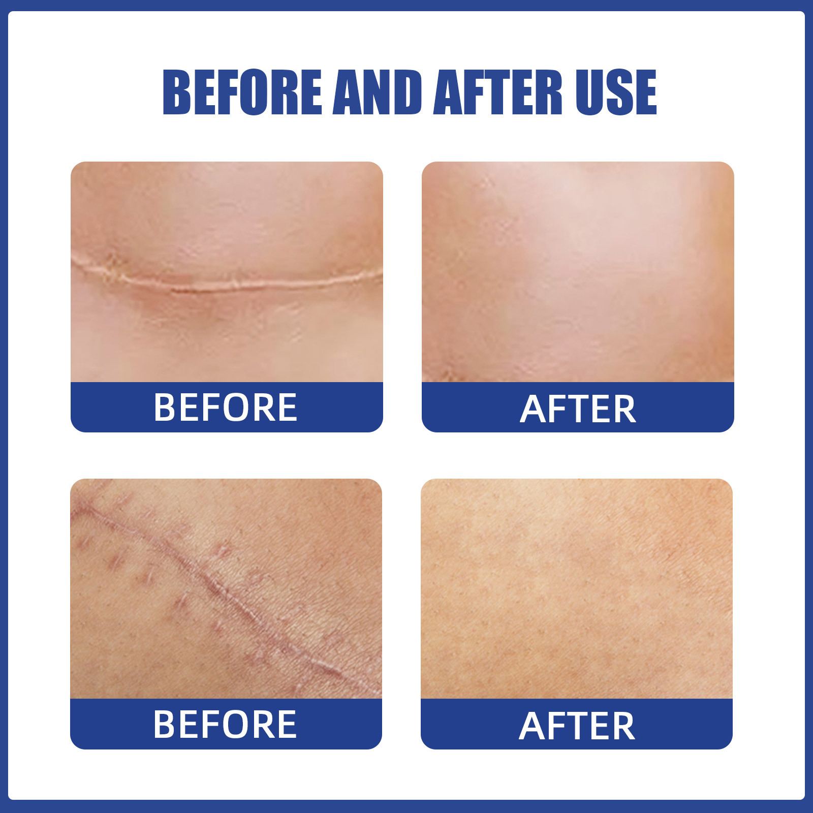 Le patch anti-cicatrice EELHOE répare la peau de manière confortable, légère et lisse les cicatrices de chirurgie mammaire_voghion.com