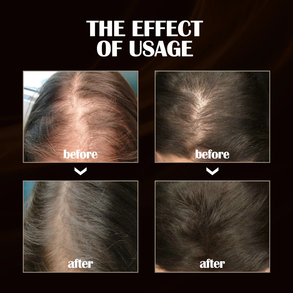 Leistungsstarkes Haarwuchs-Serum-Spray mit Ingwer, Anti-Haarausfall-Behandlungsprodukte, Reparatur, Pflege der Haarwurzeln, schnelles Nachwachsen der Haare bei Männern und Frauen_voghion.com
