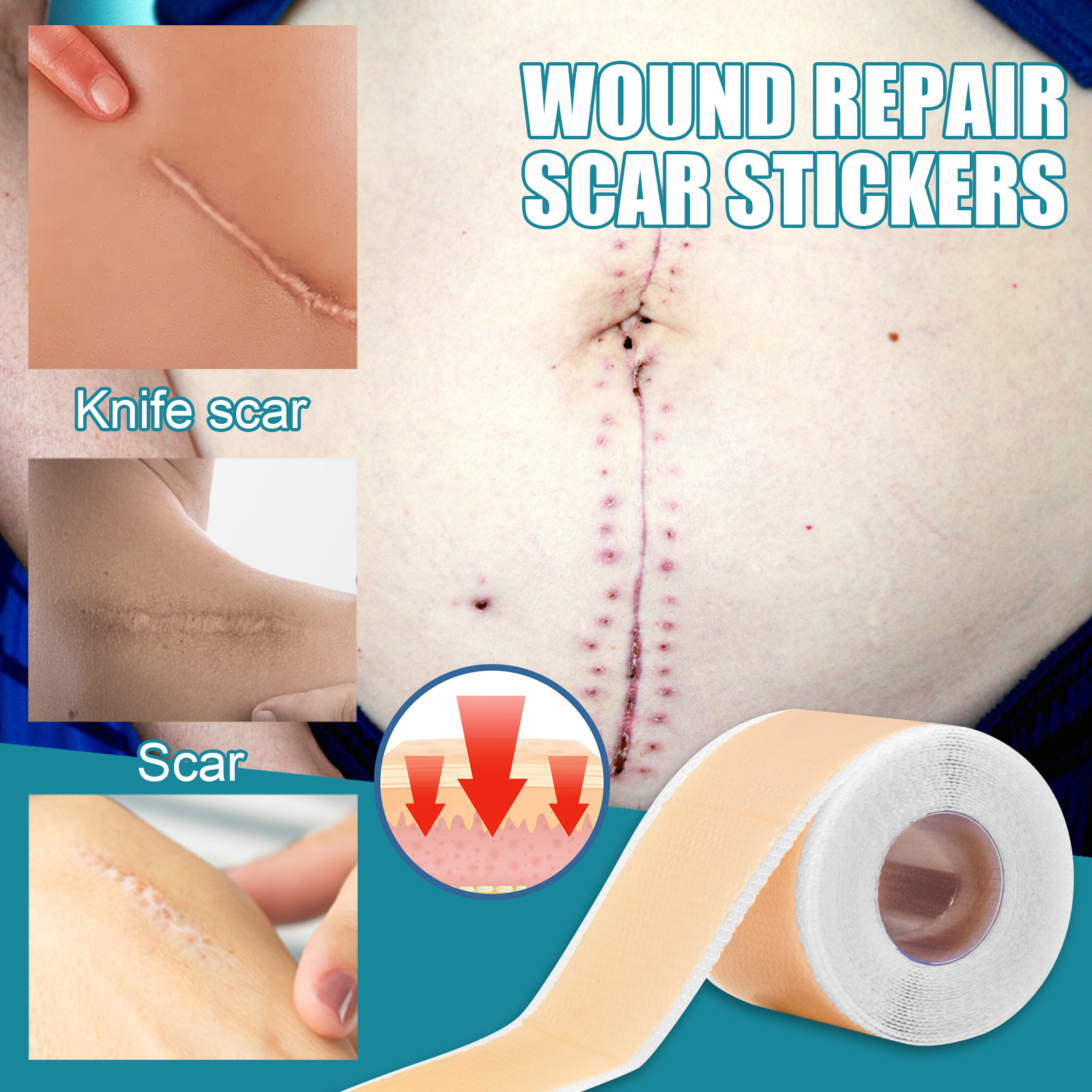 Silikonová samolepicí náplast na jizvy West&Month pro opravu pomerančové kůry, zarůstajících vrásek, vyhlazující péči o pleť a krásu_voghion.com