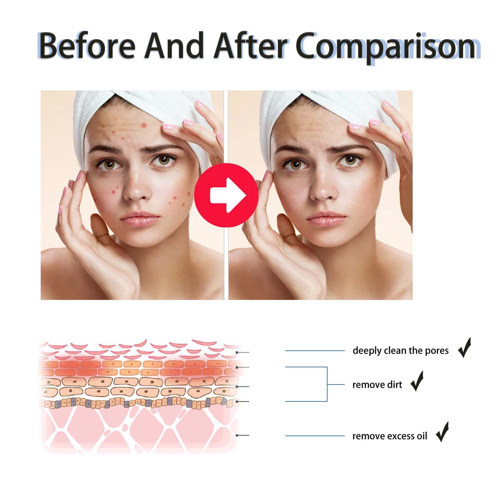 West&Month Salicylic Acid Acne Removing to fade marks, repair skin, mildly remove acne and moisturize essence_voghion.com