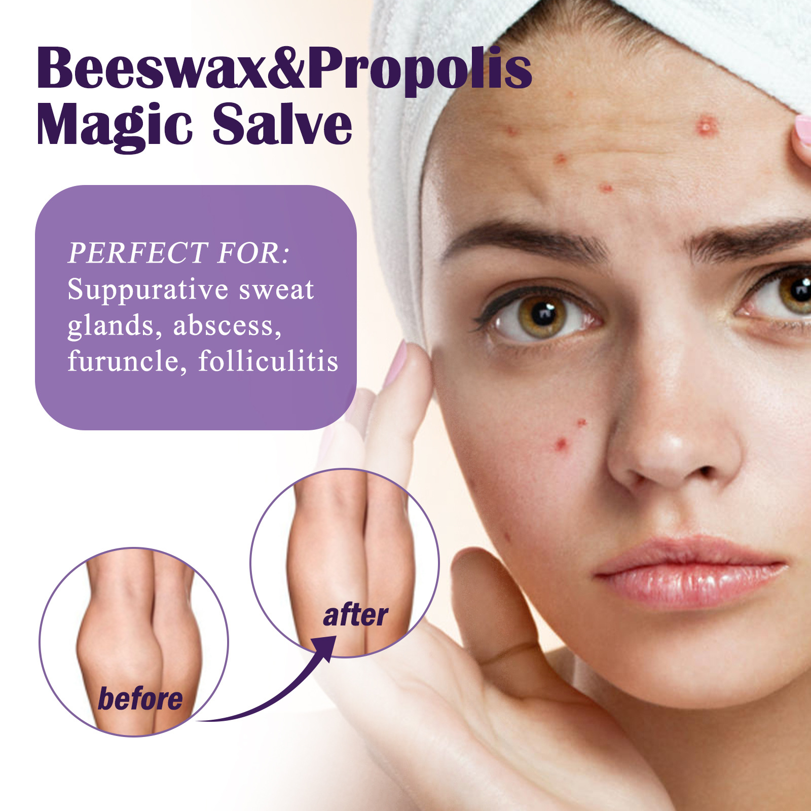 EELHOE Propolis-Reparaturcreme zur Linderung subkutaner Knoten, spendet der Haut Feuchtigkeit, repariert sanft und reinigt die Haarfollikel_voghion.com