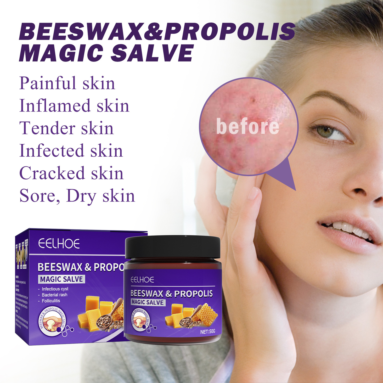 EELHOE Propolis-Reparaturcreme zur Linderung subkutaner Knoten, spendet der Haut Feuchtigkeit, repariert sanft und reinigt die Haarfollikel_voghion.com