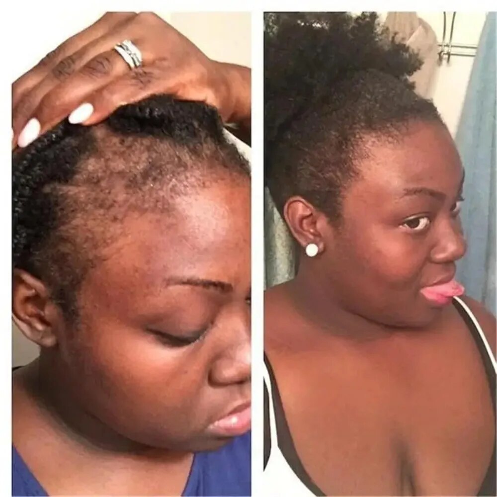 Leistungsstarkes Haarwuchs-Serum-Spray mit Ingwer, Anti-Haarausfall-Behandlungsprodukte, Reparatur, Pflege der Haarwurzeln, schnelles Nachwachsen der Haare bei Männern und Frauen_voghion.com