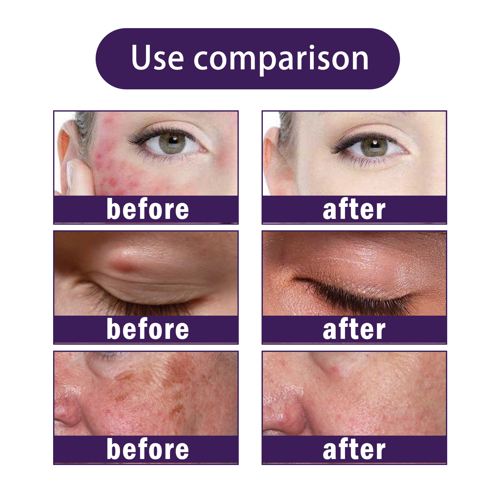 EELHOE Propolis-Reparaturcreme zur Linderung subkutaner Knoten, spendet der Haut Feuchtigkeit, repariert sanft und reinigt die Haarfollikel_voghion.com