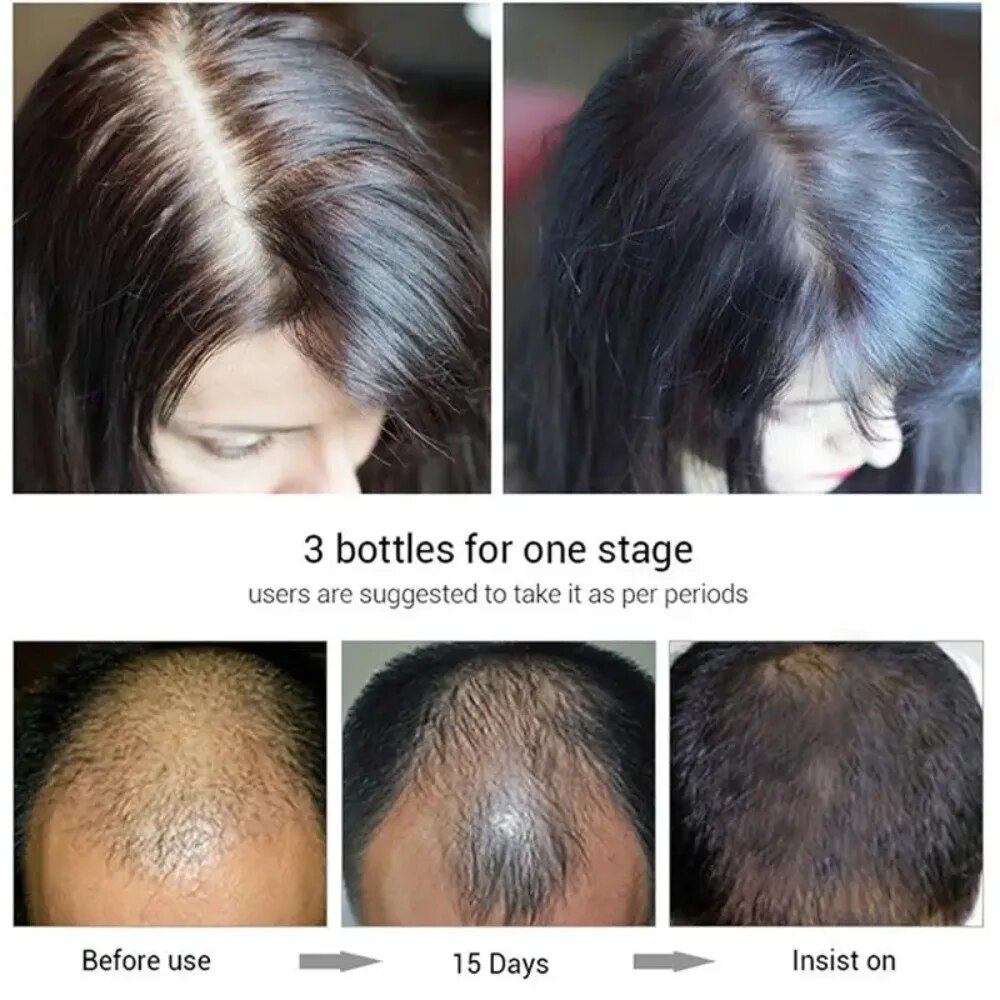 Leistungsstarkes Haarwuchs-Serum-Spray mit Ingwer, Anti-Haarausfall-Behandlungsprodukte, Reparatur, Pflege der Haarwurzeln, schnelles Nachwachsen der Haare bei Männern und Frauen_voghion.com