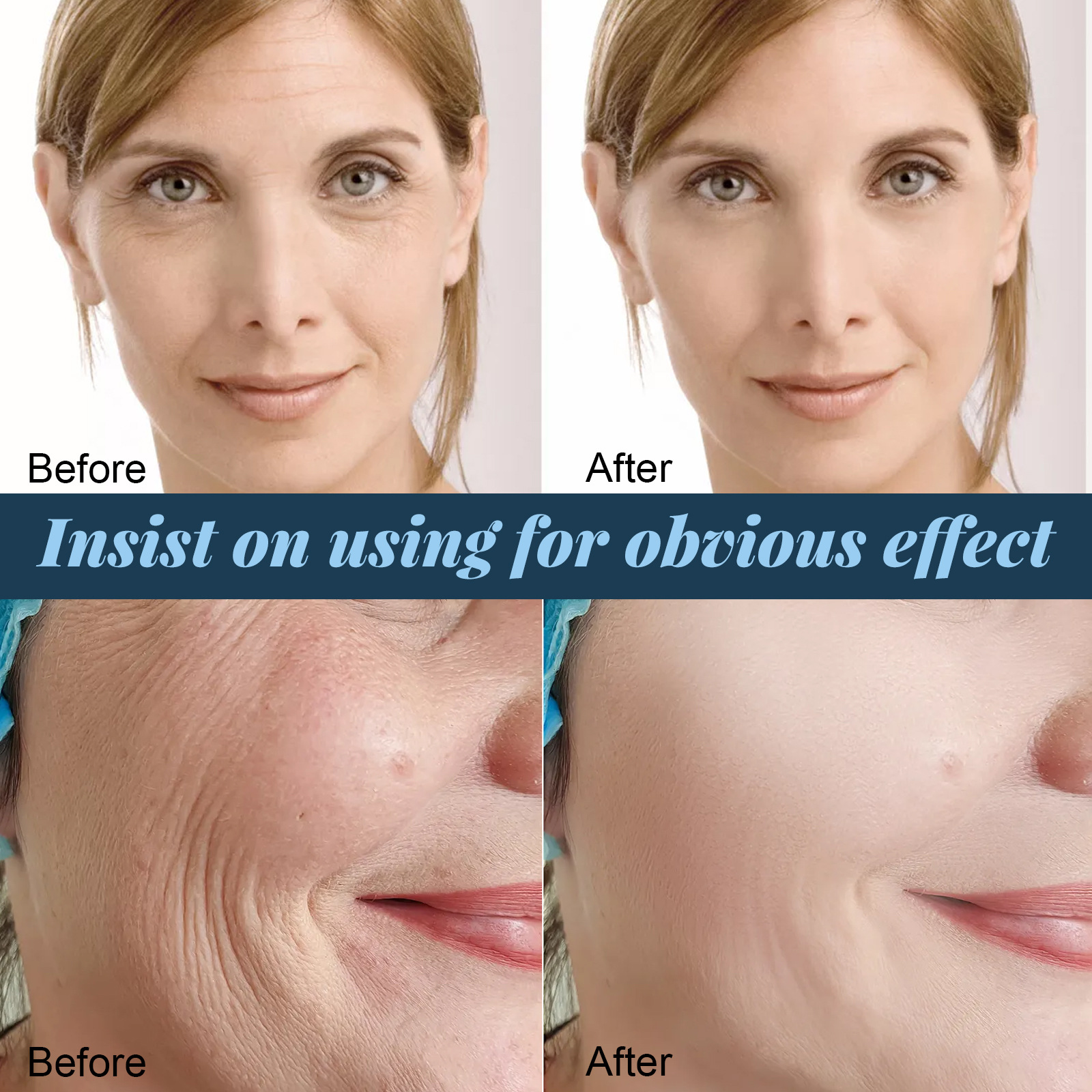 Linha de lifting de proteína EELHOE antirrugas para pele em V, lifting facial, firmeza, relaxamento dos contornos faciais, redução de medidas finas_voghion.com