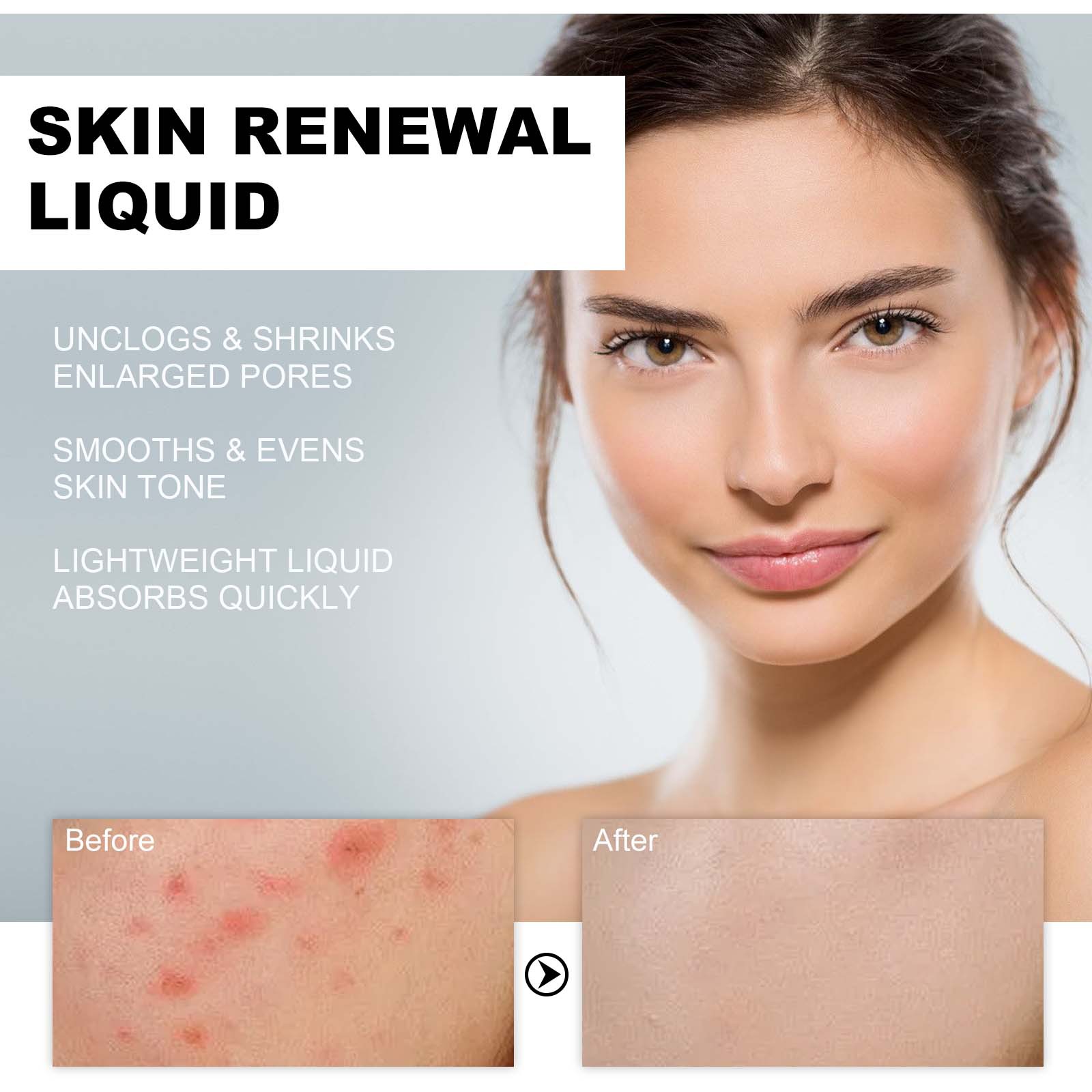 West&Month Salicylic Acid Acne Removing to fade marks, repair skin, mildly remove acne and moisturize essence_voghion.com